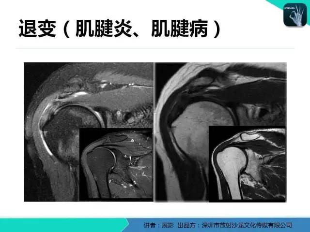【PPT】肩峰下撞击综合征和肩袖损伤的MR表现