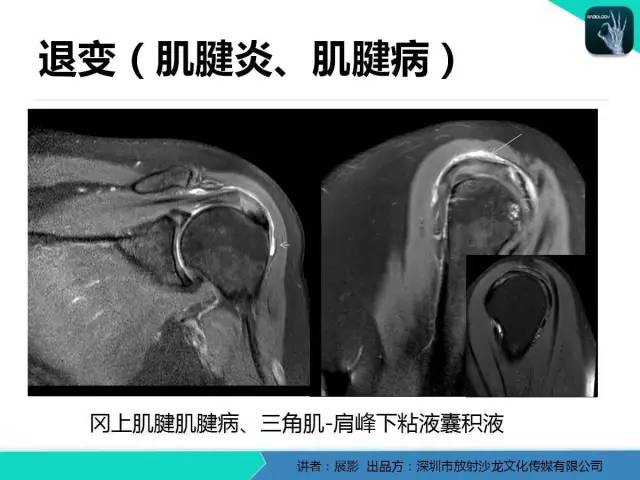 【PPT】肩峰下撞击综合征和肩袖损伤的MR表现