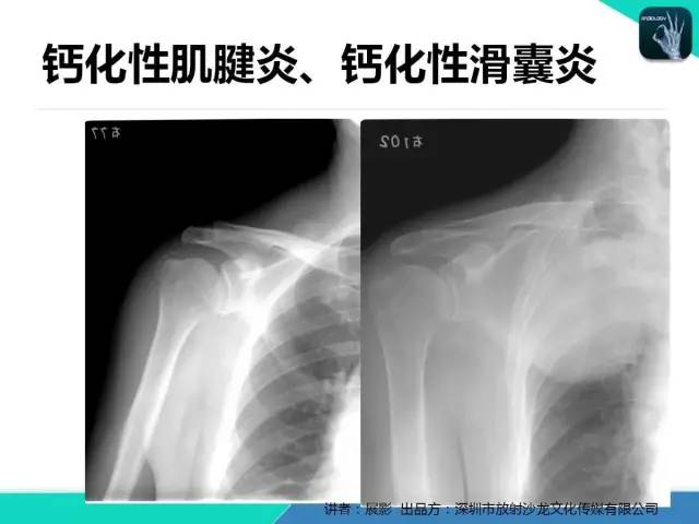 【PPT】肩峰下撞击综合征和肩袖损伤的MR表现
