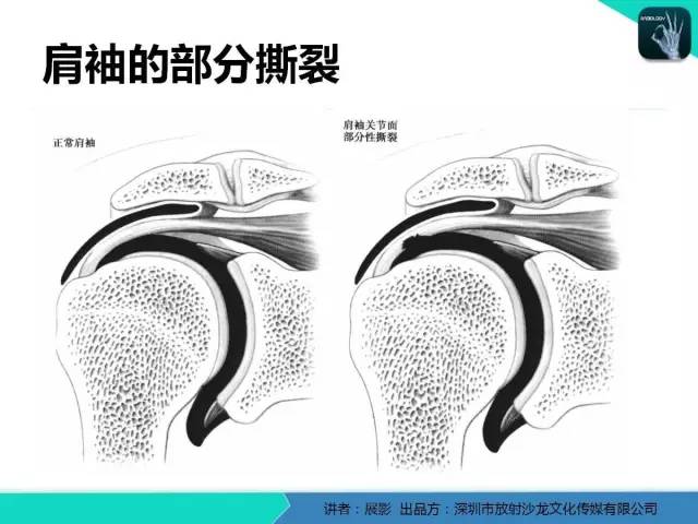 【PPT】肩峰下撞击综合征和肩袖损伤的MR表现