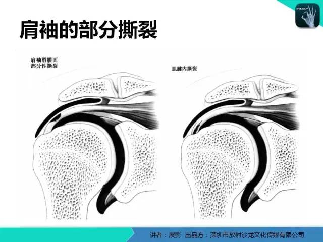 【PPT】肩峰下撞击综合征和肩袖损伤的MR表现