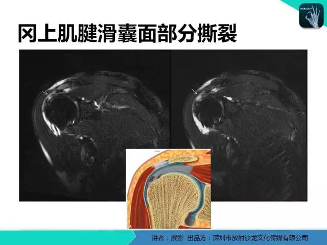 【PPT】肩峰下撞击综合征和肩袖损伤的MR表现