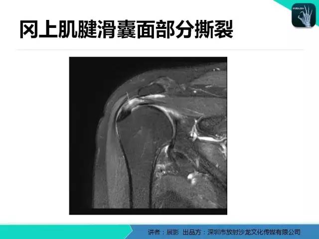 【PPT】肩峰下撞击综合征和肩袖损伤的MR表现