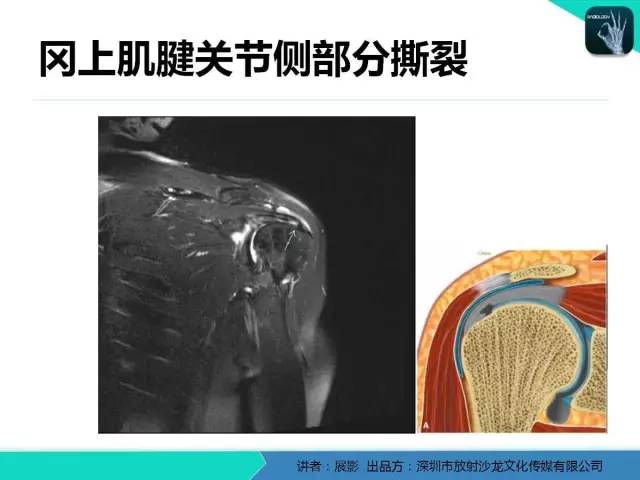 【PPT】肩峰下撞击综合征和肩袖损伤的MR表现