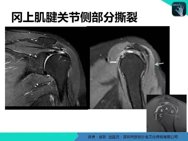 【PPT】肩峰下撞击综合征和肩袖损伤的MR表现