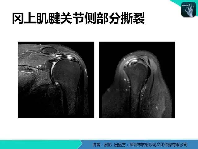 【PPT】肩峰下撞击综合征和肩袖损伤的MR表现