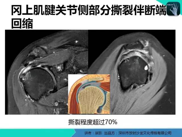 【PPT】肩峰下撞击综合征和肩袖损伤的MR表现
