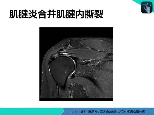 【PPT】肩峰下撞击综合征和肩袖损伤的MR表现