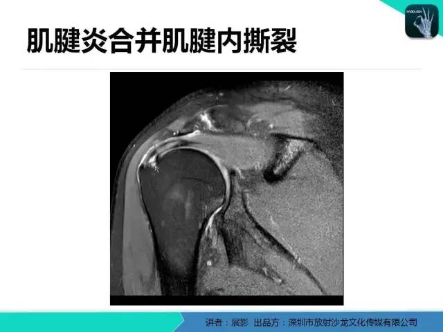 【PPT】肩峰下撞击综合征和肩袖损伤的MR表现