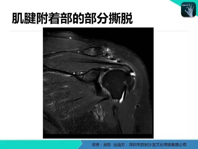 【PPT】肩峰下撞击综合征和肩袖损伤的MR表现