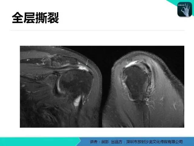 【PPT】肩峰下撞击综合征和肩袖损伤的MR表现