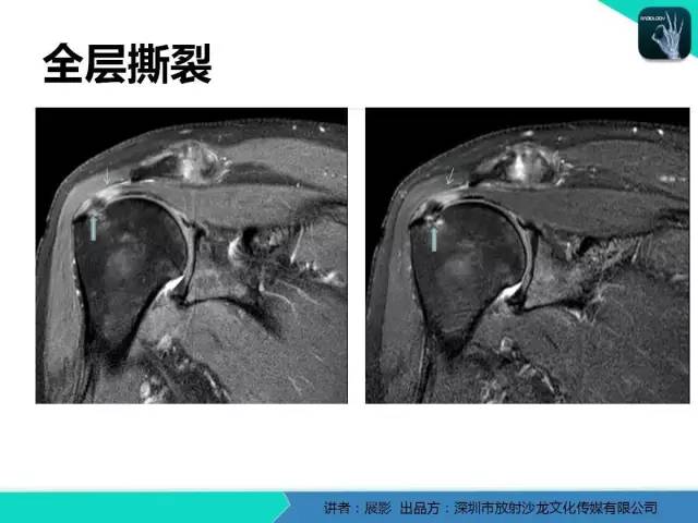 【PPT】肩峰下撞击综合征和肩袖损伤的MR表现