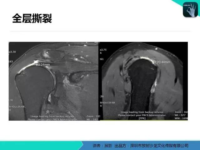【PPT】肩峰下撞击综合征和肩袖损伤的MR表现