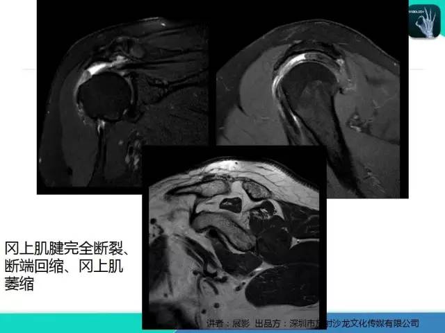 【PPT】肩峰下撞击综合征和肩袖损伤的MR表现