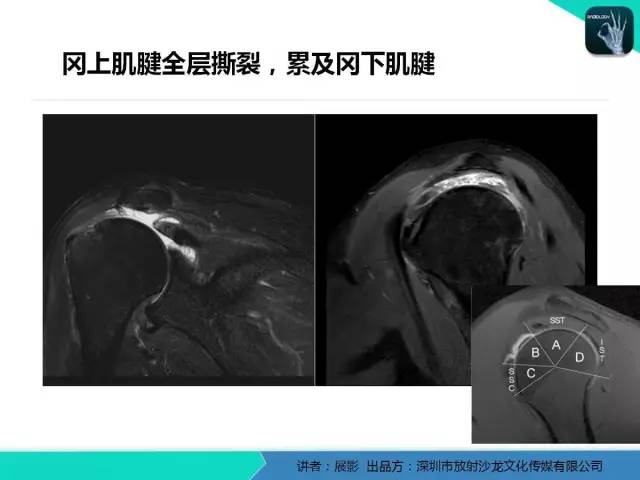 【PPT】肩峰下撞击综合征和肩袖损伤的MR表现
