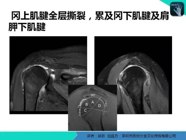 【PPT】肩峰下撞击综合征和肩袖损伤的MR表现