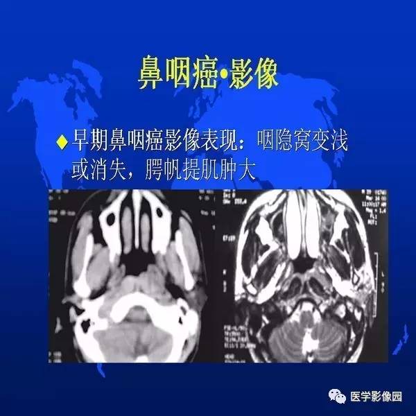 【PPT】鼻咽病变诊断与鉴别诊断