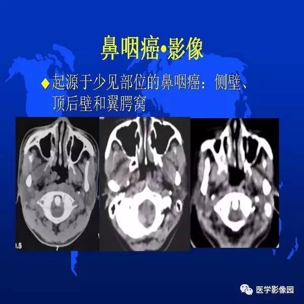 【PPT】鼻咽病变诊断与鉴别诊断