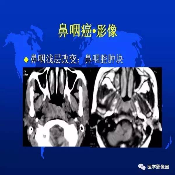 【PPT】鼻咽病变诊断与鉴别诊断