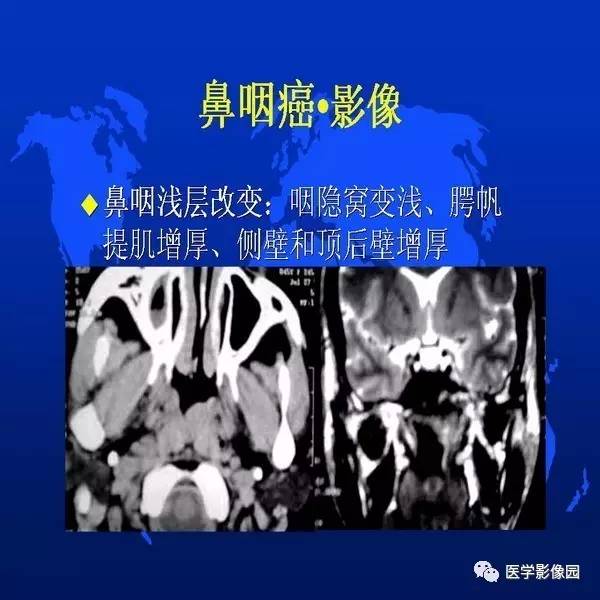 【PPT】鼻咽病变诊断与鉴别诊断
