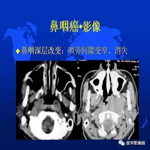 【PPT】鼻咽病变诊断与鉴别诊断