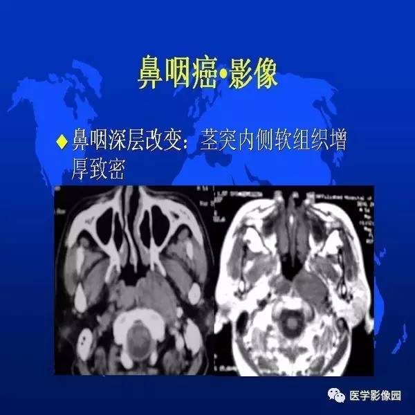 【PPT】鼻咽病变诊断与鉴别诊断