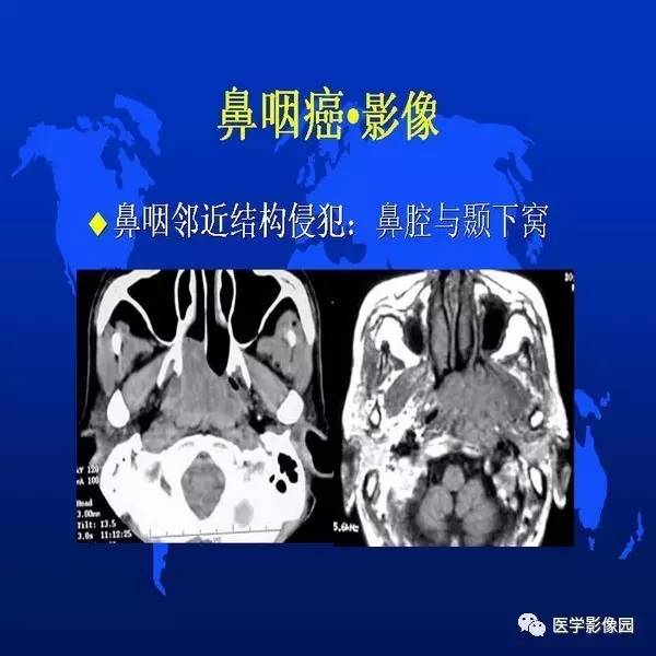 【PPT】鼻咽病变诊断与鉴别诊断