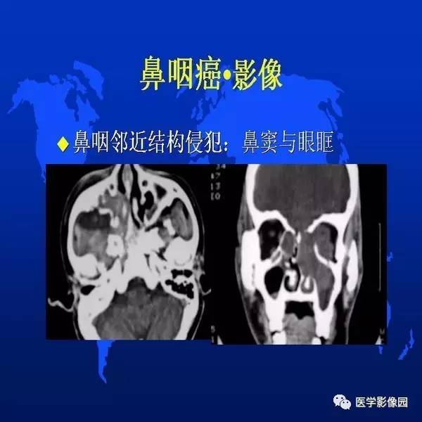 【PPT】鼻咽病变诊断与鉴别诊断