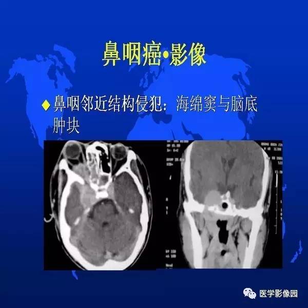 【PPT】鼻咽病变诊断与鉴别诊断