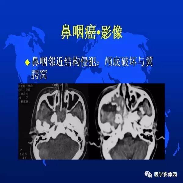 【PPT】鼻咽病变诊断与鉴别诊断