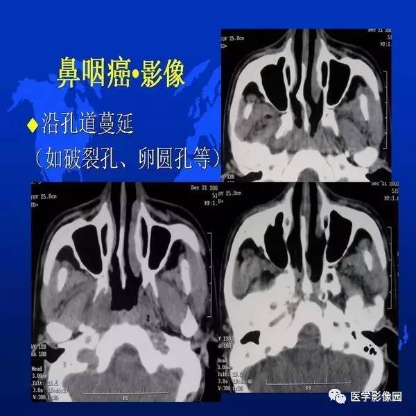 【PPT】鼻咽病变诊断与鉴别诊断