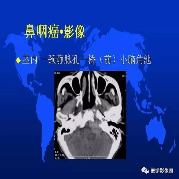 【PPT】鼻咽病变诊断与鉴别诊断