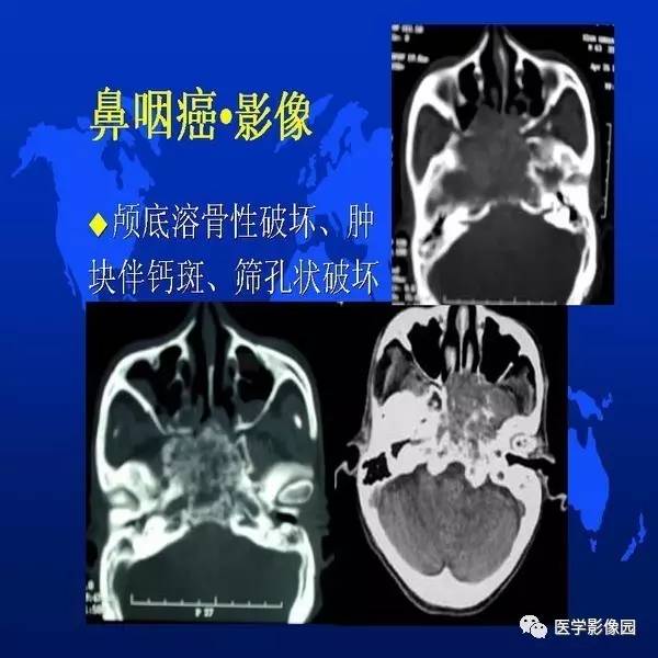 【PPT】鼻咽病变诊断与鉴别诊断