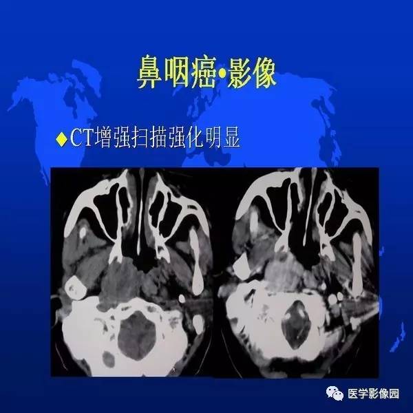 【PPT】鼻咽病变诊断与鉴别诊断