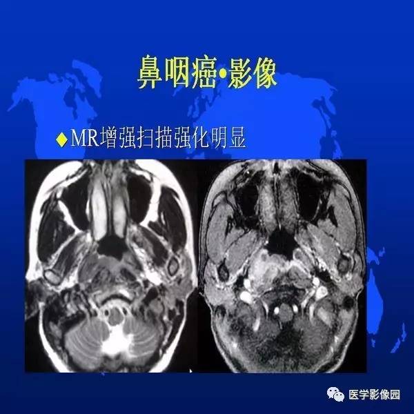 【PPT】鼻咽病变诊断与鉴别诊断