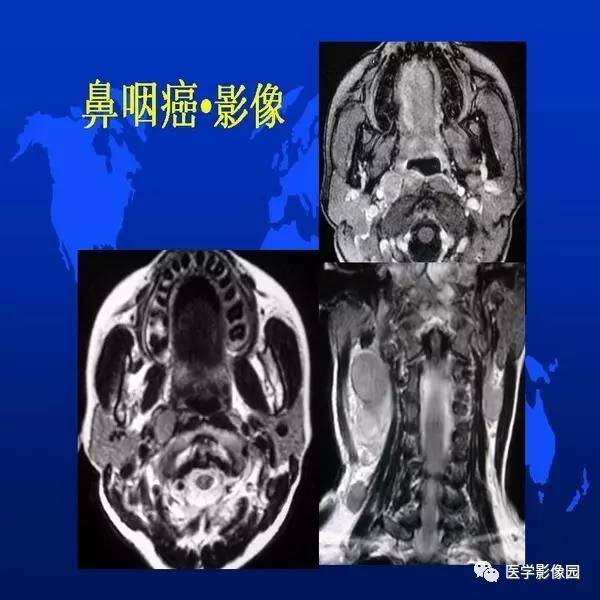 【PPT】鼻咽病变诊断与鉴别诊断