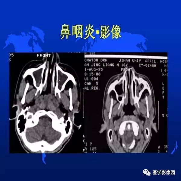【PPT】鼻咽病变诊断与鉴别诊断