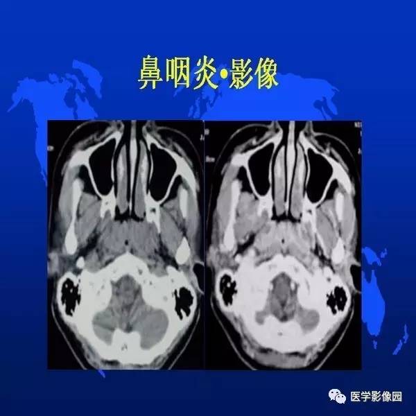 【PPT】鼻咽病变诊断与鉴别诊断