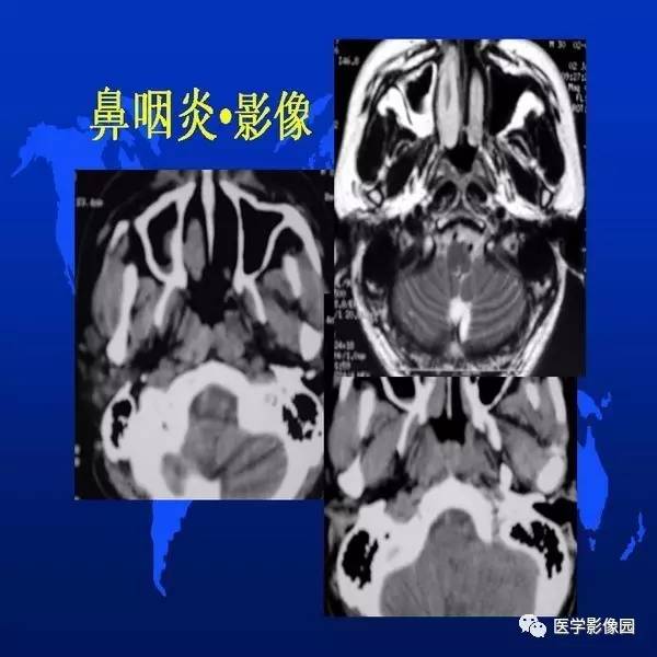 【PPT】鼻咽病变诊断与鉴别诊断