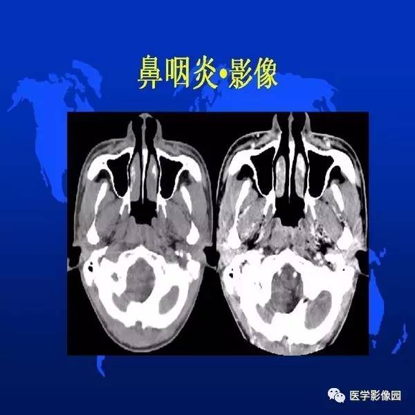 【PPT】鼻咽病变诊断与鉴别诊断
