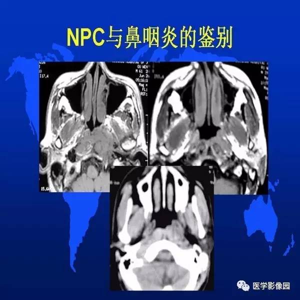 【PPT】鼻咽病变诊断与鉴别诊断