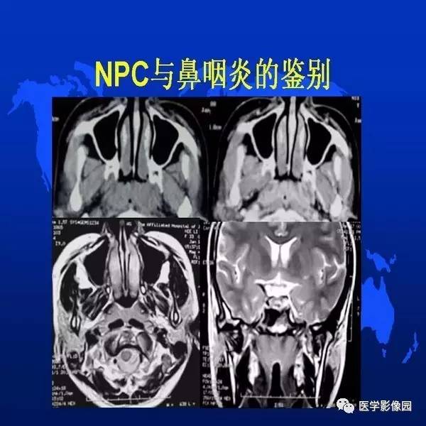 【PPT】鼻咽病变诊断与鉴别诊断