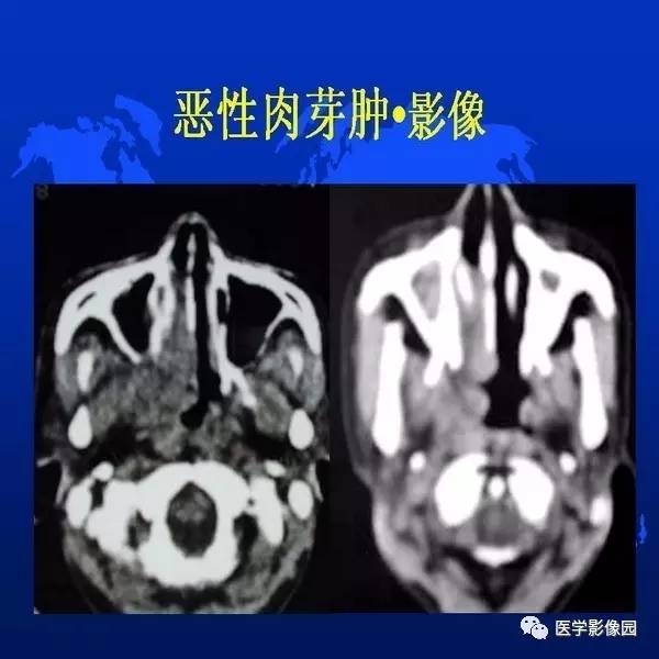 【PPT】鼻咽病变诊断与鉴别诊断