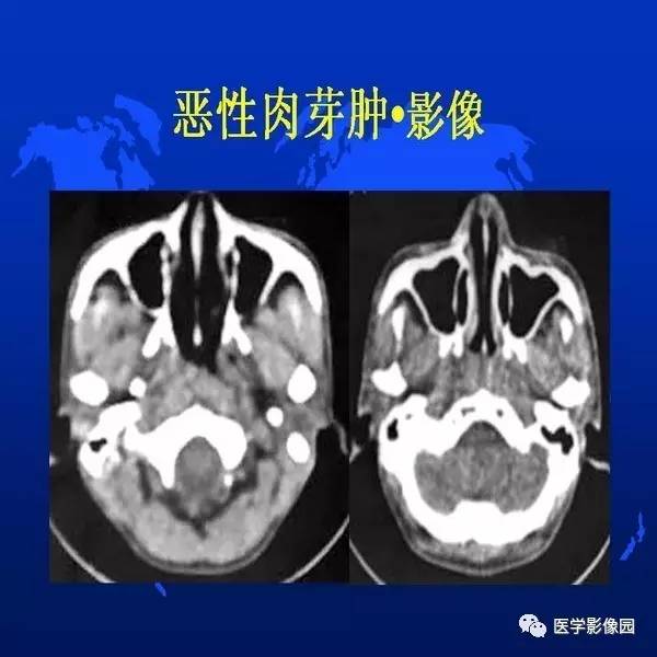 【PPT】鼻咽病变诊断与鉴别诊断