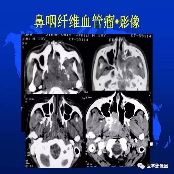 【PPT】鼻咽病变诊断与鉴别诊断