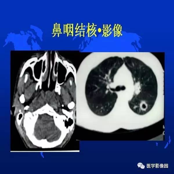 【PPT】鼻咽病变诊断与鉴别诊断