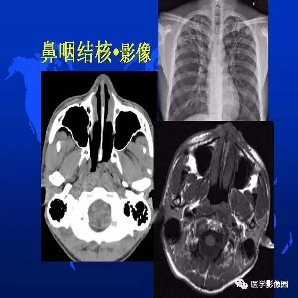 【PPT】鼻咽病变诊断与鉴别诊断