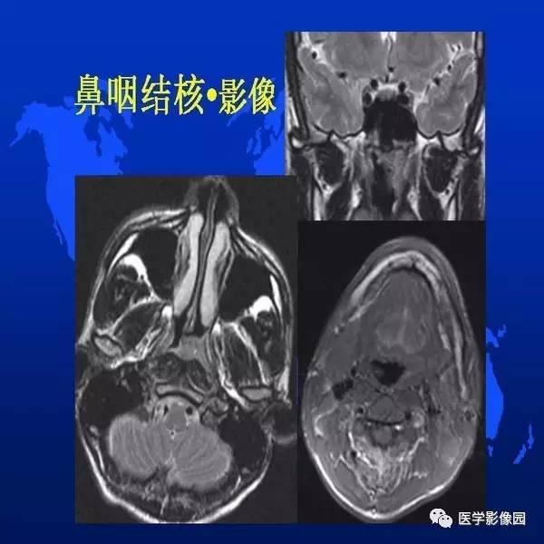 【PPT】鼻咽病变诊断与鉴别诊断