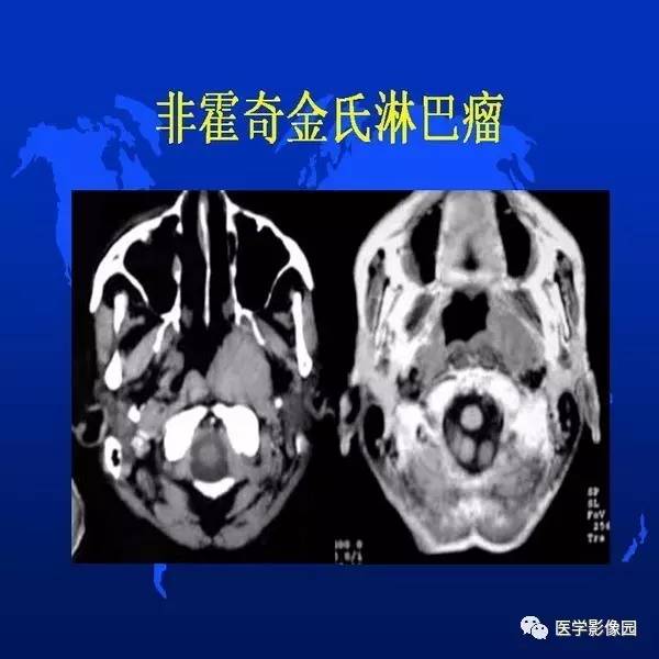 【PPT】鼻咽病变诊断与鉴别诊断