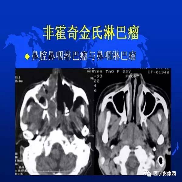 【PPT】鼻咽病变诊断与鉴别诊断
